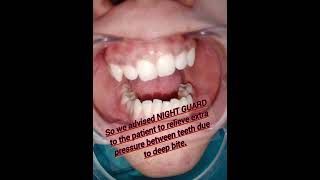 Dental NIGHT GUARDdentalcaredentistorthodonticsbestdentistrybookyourappointmentviralshort [upl. by Cadel]