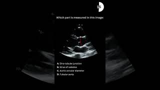 Echocardiography board practice question 30 [upl. by Kennard66]