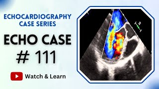 Echocardiography Case 111  Echocardiogram Interpretation Made Easy  TOACS [upl. by Gian928]