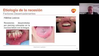 Recesión gingival y sensibilidad dental [upl. by Aicnarf]