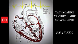 Arythmies animation cardiaque et ECG  Tachycardie Ventriculaire Monomorphe Shorts [upl. by Ayle]