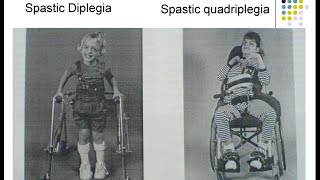 Cerebral Palsy CP  Spastic Diplegia Paraplegia Hemiplegia Sequelae Consequences Treatment Options [upl. by Ennaul420]