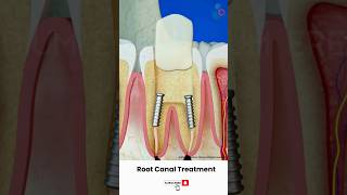 Root Canal Treatment Procedure ↪ 3D Medical Animation Shorts RootCanal Tooth [upl. by Louella803]