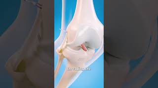 How Surgeons Fix Torn Ligaments in Your Knee short [upl. by Misti]