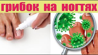 Рецепт от грибка на ногтях ног и рук [upl. by Barcot]