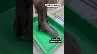 Can leeches remove varicose veins leech therapy for varicose veins shortvideokzhijamareelsdr [upl. by Enihpets1]