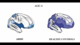 Brain matures a Few Years Late in ADHD but follows Normal pattern [upl. by Emoraj]