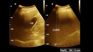 Hepatomegaly  Mild hepatomegaly with fatty change  Ultrasonography report  Amader Hospital [upl. by Ranchod308]