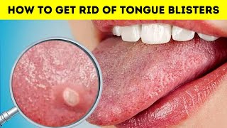 How to get rid of tongue blisters canker sore on your tongue fast at home [upl. by Piane914]