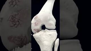 Infiltración con Ácido Hialuronico Artrosis de Rodilla Desgaste salud parati viral fypシ fyp [upl. by Ydoc908]