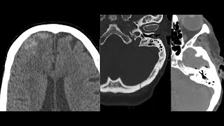 Complexed intracranial hemorrhage pneumocephalus and skull fracture [upl. by Kennan]