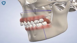 Orthognathic Surgery at Columbia Basin Oral amp Maxillofacial Surgeons [upl. by Wesle897]