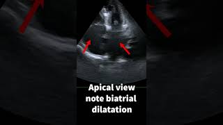 Restrictive cardiomyopathy [upl. by Ambur]