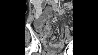 Appendicitis  perforated  complicated  appendicoliths present [upl. by Sammons508]