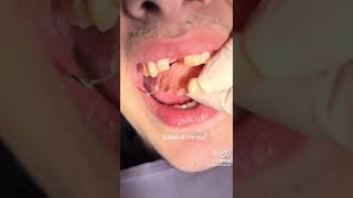 Temporary way of replacing a missing front tooth with a flipper🐬🦷 shorts viral teeth tiktok [upl. by Holbrook]