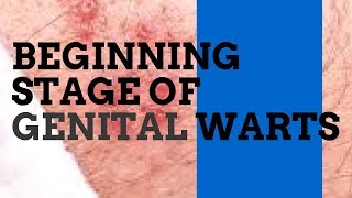 Beginning Stage of Genital Warts [upl. by Attaynek41]