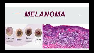 Malignant Melanoma Pathogenesis Morphology and Clinical picture [upl. by Ahsimin]