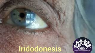 Iridodonesis Clinical Signs shorts Subluxation of Lens [upl. by Bible]