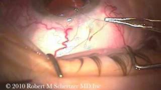 Transconjunctival suturing sclera [upl. by Aicilanna]