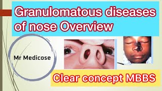 Granulomatous diseases of nose Overview [upl. by Maryly401]