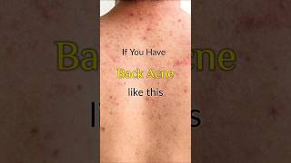 How to get Rid of It Back acneBackne for good backacne fungalinfections fungalacne explore [upl. by Nnyliak26]