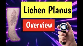 Lichen planus causes treatment diagnosis management [upl. by Naelopan]