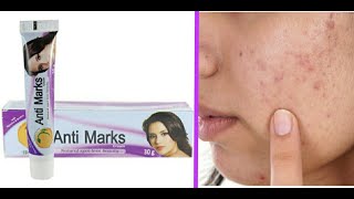 Bio Valley quotAnti Marks Creamquot  Honest Review  Hindi  Must Watch [upl. by Farley]