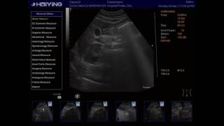 ULTRASOUND DUODENUM amp PYLORIC SPHINCTER [upl. by Elyn]