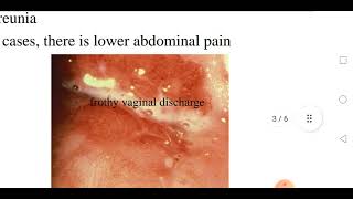 Trichomoniasis [upl. by Enram]
