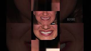 Underbite Correction without Jaw Surgery [upl. by Kramer]