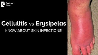 CELLULITIS vs ERYSIPELAS Know more about these SKIN INFECTIONSDr Rajdeep Mysore  Doctors Circle [upl. by Iden]