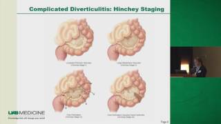 Diverticulitis To Operate or Not [upl. by Kelson479]