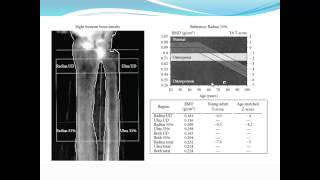 Bariatric Osteomalacia Fiona Cook MD  Internal Medicine Grand Rounds [upl. by Zetneuq]