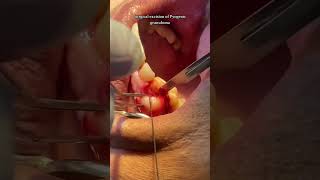 Surgical excision of Pyogenic Granuloma [upl. by Roice143]