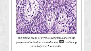 mycosis fungosis [upl. by Sandro]