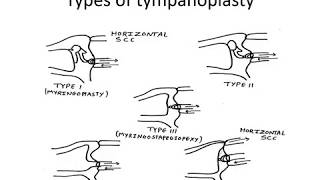 Conductive Hearing Loss  Tympanoplasty  ENT Lecture Series [upl. by Anaeg607]