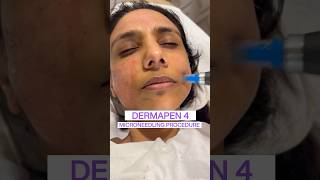 Dermapen microneedling  Eevara Clinic Noida  For appointments 📞 at 7024110785 [upl. by Siddon]