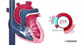 Implantable Cardioverter Defibrillator  How it works [upl. by Tnomal58]