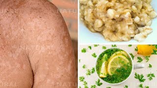 3 Natural Remedies for Treating Tinea Versicolor at Home Pityriasis Versicolor [upl. by Matheson]