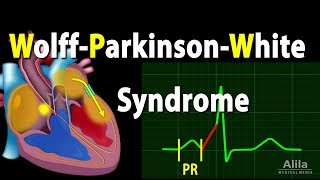 WolffParkinsonWhite Syndrome Pathophysiology PreExcitation and AVRT Animation [upl. by Blinnie574]