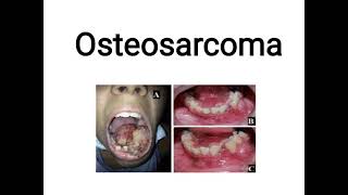 osteosarcoma [upl. by Steven390]