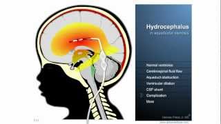 Hydrocephalus  Definition treatment and complications [upl. by Jahn66]