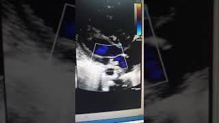 Case53 echocardiography Ebstein anomaly [upl. by Yspyg701]