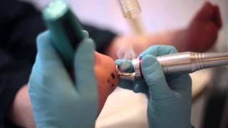 Laser treatment of Verruca [upl. by Aryc]