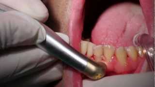 gingivectomia y gingivoplastia con laserDr joaquin garcía rodriguezAlgeciras [upl. by Elbon]