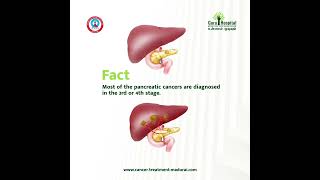 Pancreatic Cancer Facts Best Pancreatic Cancer Treatment in Madurai Guru Hospitals [upl. by Poucher853]