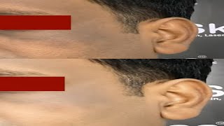 Treating Acanthosis Nigricans by Laser and Chemical Peel at SkinaaClinic treatingacanthosis short [upl. by Efar964]