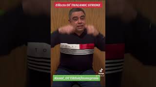 Effects of thalamic stroke [upl. by Hsejar]