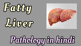 Fatty liver in hindi  Pathology   cause  pathogenesis  EASY WAY TO UNDERSTAND [upl. by Jesus]