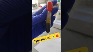 Widal tyfoid test widaltest viralfevers fever viralshorts yt ytshorts practical lab short [upl. by Neroled]